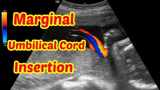 Marginal Umbilical Cord Insertion [upl. by Eiveneg607]