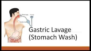 Gastric Lavage Stomach Wash [upl. by Alamac]