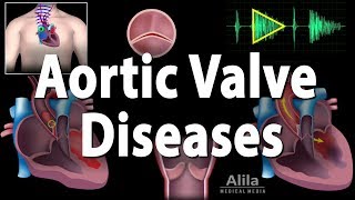 Aortic Valve Disease Animation [upl. by Hailat]