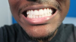 Crest 3D Whitestrips • 3 Months Later ReviewTips Whiten Your Teeth [upl. by Tail72]