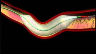 Angiogram and Coronary Angioplasty Procedure Cardiology [upl. by Tillion]