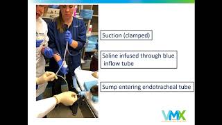 Wholelung lavage procedure in pulmonary alveolar proteinosis [upl. by Phoebe]