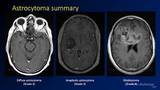 Imaging brain tumors  2  Astrocytomas [upl. by Photima339]