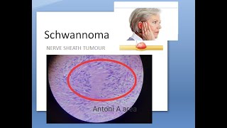 Pathology 901 a Schwannoma Vestibular Acoustic Neuroma Antoni NF2 MERLIN Verocay Hitzelberger BERA [upl. by Ikcim]