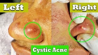 Drainage de lacné kystique sur le nez  cystic acne extraction [upl. by Orola766]