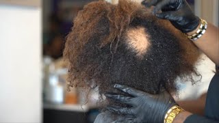 Alopecia Areata Causes SIgns and Symptoms Diagnosis and Treatment [upl. by Chapman]