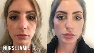 Before and After Micro Needling  Nurse Jamie [upl. by Astto]