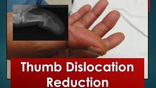 Thumb Dislocation Reduction [upl. by Aihsoek]