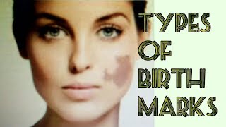 Types of Birthmarks II What are Birthmarks [upl. by Drice226]