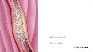 Balloon Angioplasty and Stenting Animation [upl. by Lynnet233]