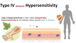 Type IV delayed hypersensitivity [upl. by Enimasaj]