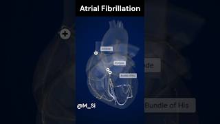 Atrial Fibrillation [upl. by Gnil182]