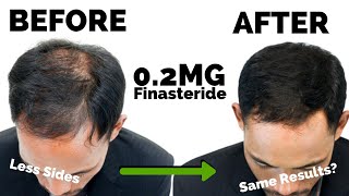 Microdosing Finasteride BREAKTHROUGH 02mg  New Dosage [upl. by Gairc]