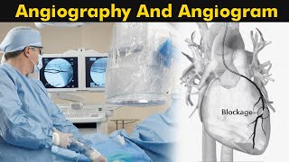 ANGIOPLASTY PROCESS [upl. by Culbertson]