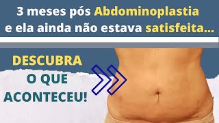 Resultados de Abdominoplastia como melhorar o seu abdome [upl. by Tybi]