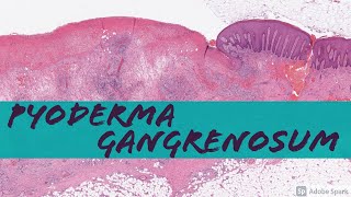 Pyoderma Gangrenosum vs NonSpecific Chronic Ulcer Changes [upl. by Garvin78]