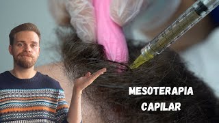 ¿FUNCIONA LA MESOTERAPIA CAPILAR [upl. by Norling]