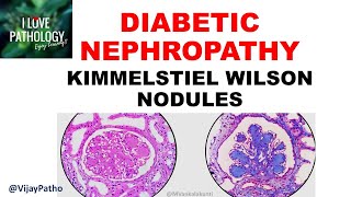 DIABETIC NEPHROPATHY Pathophysiology amp Morphology [upl. by Driscoll]