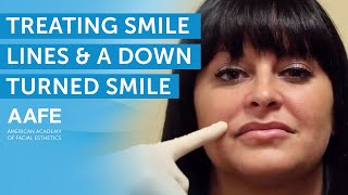 Treating Smile Lines and a Downturned Smile  AAFE [upl. by Neeven]