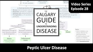 Peptic ulcer disease [upl. by Sargent]