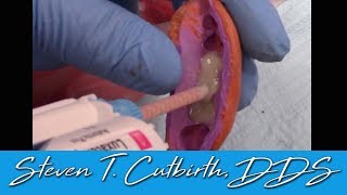 Temporary Crowns Quick and Easy Fabrication  Dental Minute with Steven T Cutbirth DDS [upl. by Eecyak559]