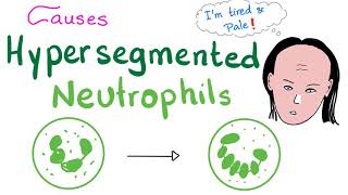 Hypersegmented Neutrophils  Anemia [upl. by Page970]