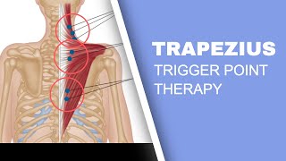 Trapezius Trigger Points and Headaches [upl. by Iliak]