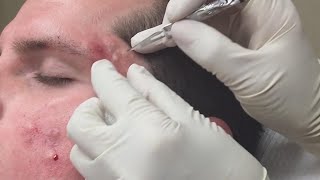 Super Satisfying Blackhead Removal [upl. by Wickham]