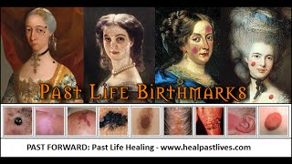 Birthmarks  Birth Marks Caused By Past Lives [upl. by Lois34]