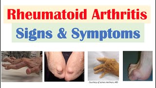 Rheumatoid Arthritis RA Signs amp Symptoms amp Associated Complications [upl. by Nessej]