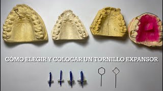 Cómo elegir y colocar un Tornillo Expansor [upl. by Jemie]