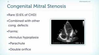 Mitral Stenosis Basics [upl. by Nashner370]