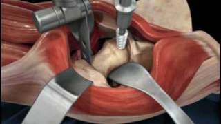 X ray hip joint osteoarthritis [upl. by Malda]