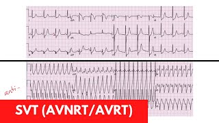 SVT AVRT AVNRT  For DO MD NP PA Part 3 [upl. by Morven]