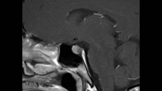 Pituitary Microadenoma [upl. by Rey]