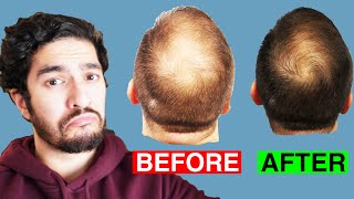 Is PRP a MIRACLE Cure for Hair Loss [upl. by Jamnes]