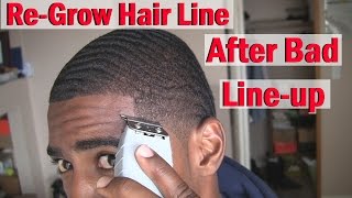 How to ReGrow your Hairline Naturally After Bad line upHaircut [upl. by Lanfri]