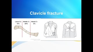 Clavicle fracture [upl. by Trevlac]