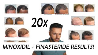 20 Finasteride and Minoxidil before and after Results NW2  NW56 [upl. by Mook786]