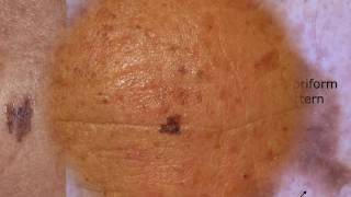 Difficult seborrheic keratoses  Dr Caterina Longo [upl. by Ardnama954]