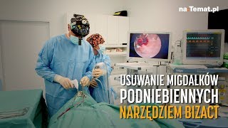 Usuwanie migdałków podniebiennych narzędziem BiZact [upl. by Atimed]