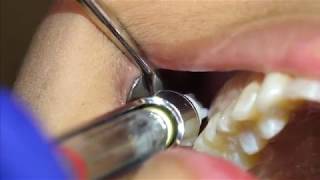 Posterior Superior Alveolar PSA Injection Demonstration and Overview 4K [upl. by Esetal]