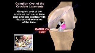 Ganglion Cysts Around The Knee  Everything You Need To Know  Dr Nabil Ebraheim [upl. by Arreyt223]