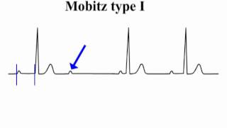 ECG Interpretation  AtrioVentricular Block [upl. by Koralie]