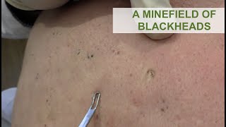 A Minefield of Blackheads  Dr Derm [upl. by Caneghem]