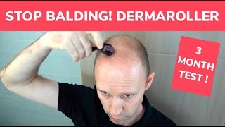 STOP BALDING  Dermaroller 3 Month Test and Tutorial [upl. by Trescott]