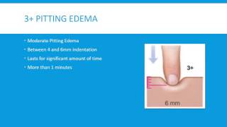 Pitting Edema Grading Scale 4 Levels [upl. by Vezza]