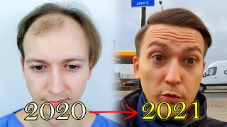 FUE Hair Transplant Growth Timeline  Before amp After [upl. by Llehsram298]