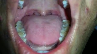 Tongue Fasciculation in MND [upl. by Aerdnaxela8]