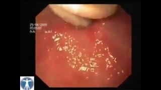 Remove Ascaris Worm Inside Stomach [upl. by Ingemar203]